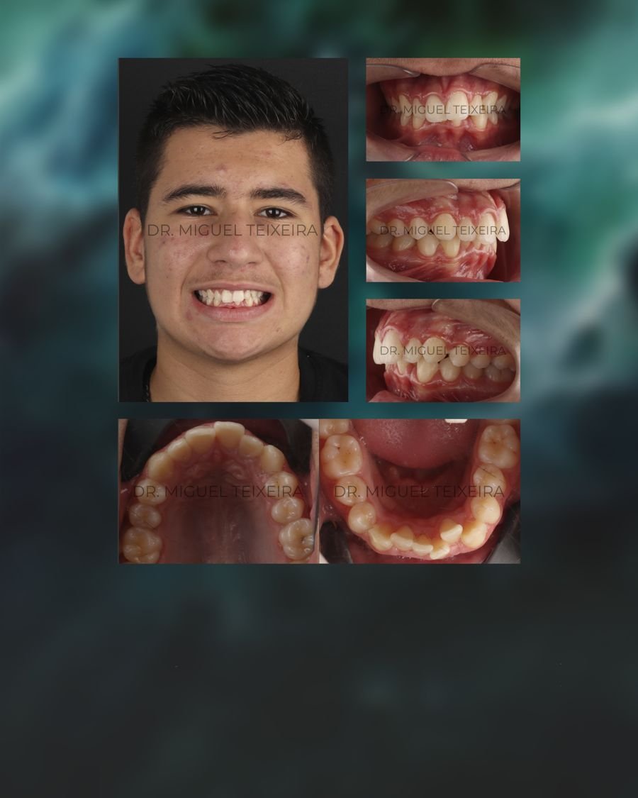 Caso clínico ClearX — periodontitis y diastemas
